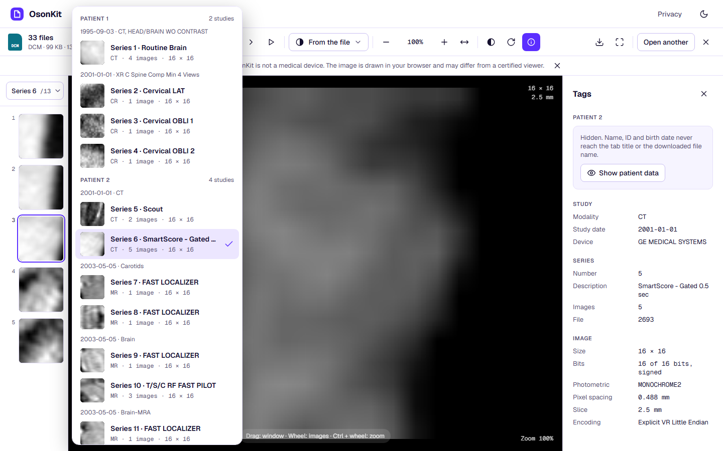 Un estudio de dos pacientes abierto en OsonKit: series agrupadas por paciente y estudio, nombres ocultos